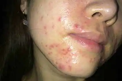 【嘴角长痘痘怎么办】内调外养祛痘美颜摆脱痘痘肌肤