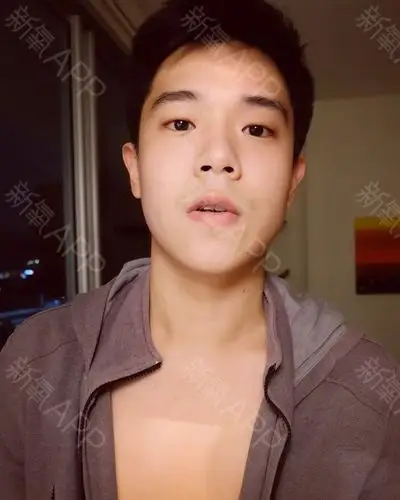 脱唇毛好不好_效果图_氧气dmv3c80脱唇毛术后第0天_新氧美容整形