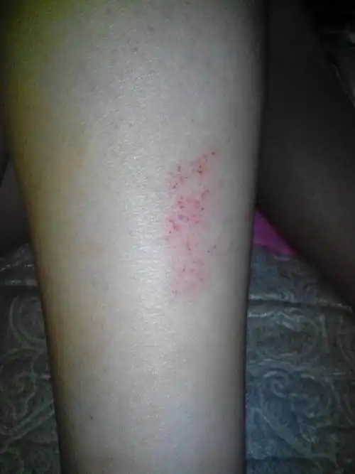 腿上涂脱毛膏后,成功脱毛第二天,有一块火辣辣的疼,还有血点,像擦伤一