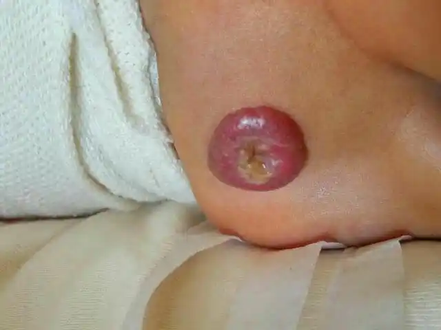 略高于皮肤表面,医生说血管瘤可能性大,有可能是脊柱裂吗?