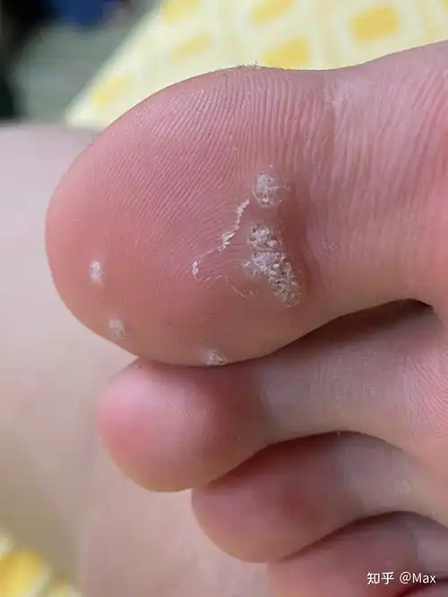 疣(脚底多颗疣状增生物) - 知乎