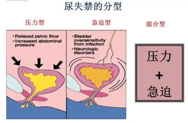 3,混合性尿失禁大多数女性都是这种类型的尿失禁.