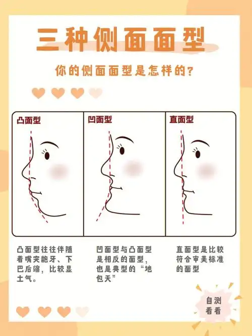 从口腔正畸学的角度来说,可以根据软组织突度将把人的侧貌分为直面型