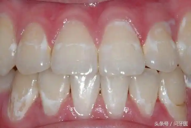 牙齿的白斑