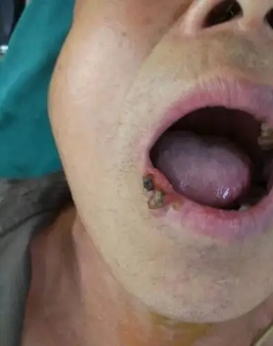 口腔癌都是拖出来的病专家提醒有这四种表现当心口腔癌已上门
