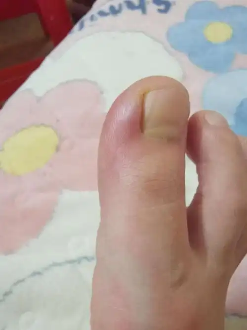 甲沟炎 - 好大夫在线