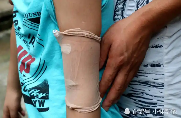 图为小宝玉胳膊上每天带着化疗用的医疗用品.