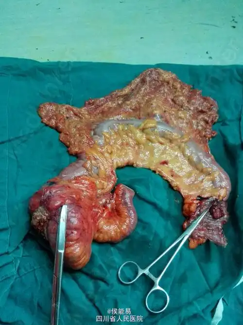 一例同时性多原发结肠癌经验分享