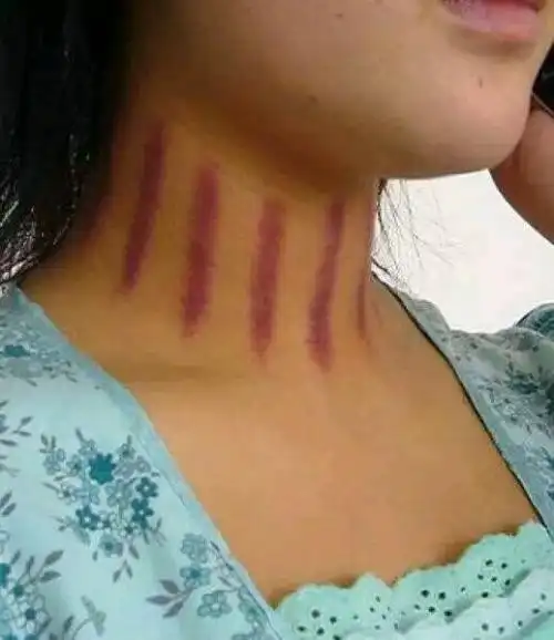 头晕撮痧有来头 - 经络网