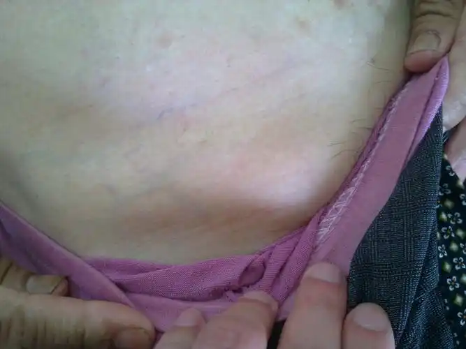 全身多处淋巴结肿大