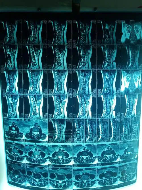 特巨大游离性脱出腰间盘突出症