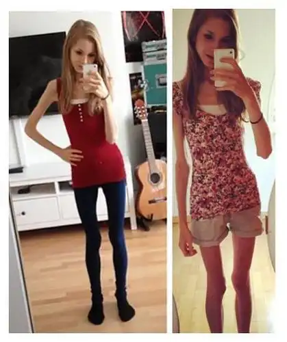 这是世界最瘦的女孩,最瘦时体重只有22公斤!(5)