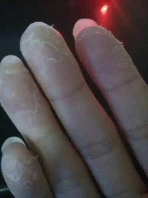 手指脱皮怎么办