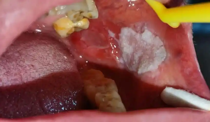 白白软软的没啥感觉,这种癌前病变要当心!