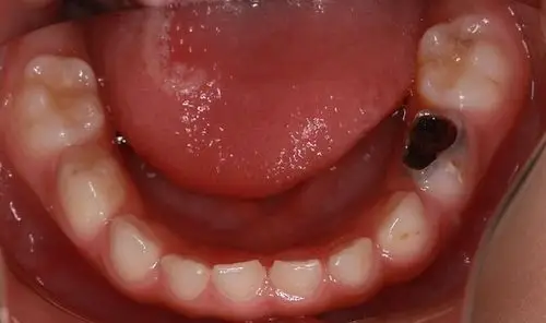 乳牙不是会换吗?为什麼要治疗?