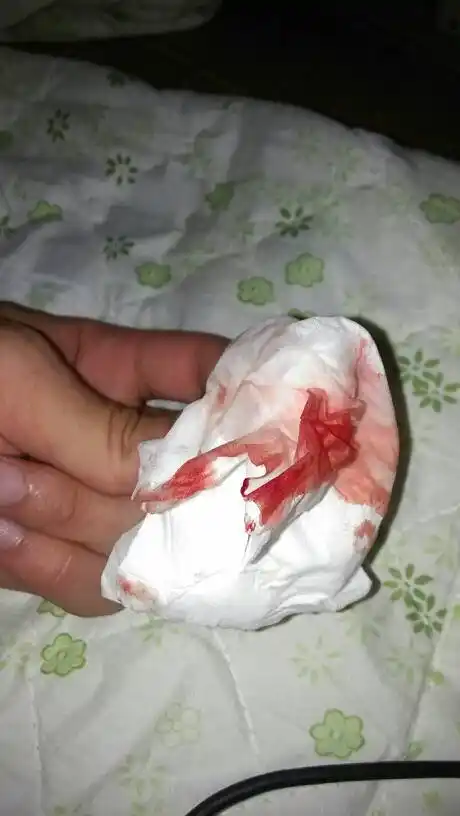 流鼻血,怎么办010101