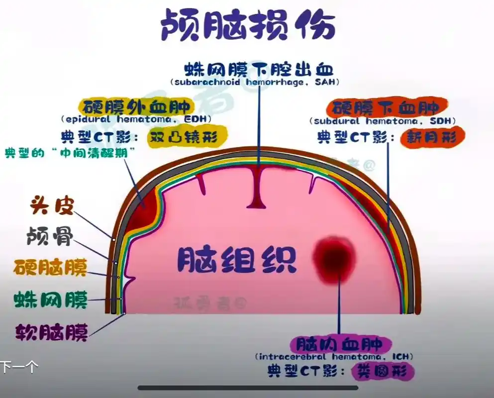 医学科普 #头颅血肿 #颅脑损伤 #医学生 - 抖音