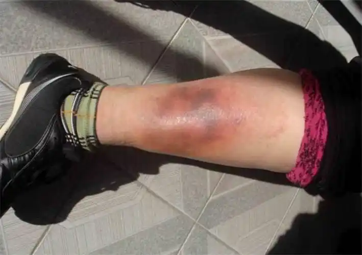 足部浅表型静脉炎图片