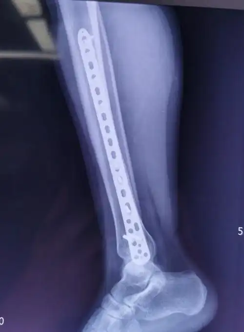 曹某某,男,15岁,诊断:右胫腓骨螺旋形骨折,闭合复位mipo接骨板技术内