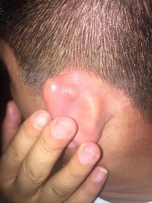 耳朵上长了个包,近期2年左右长的,平时没感觉,使劲按有点感觉,请问是