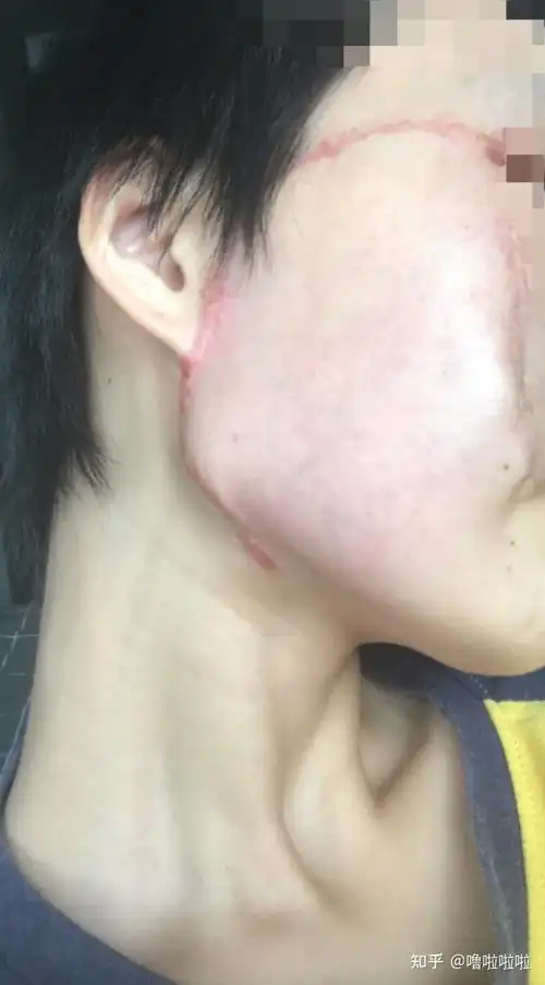 扩张器手术小记