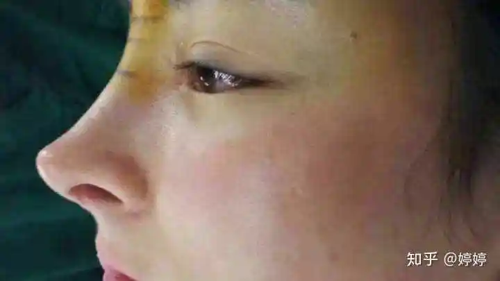 隆鼻失败的概率高吗?