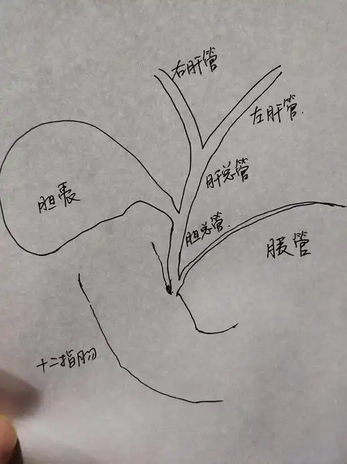 胆囊结石与胆管结石图解_胆囊结石_介绍_症状表现 - 好大夫在线