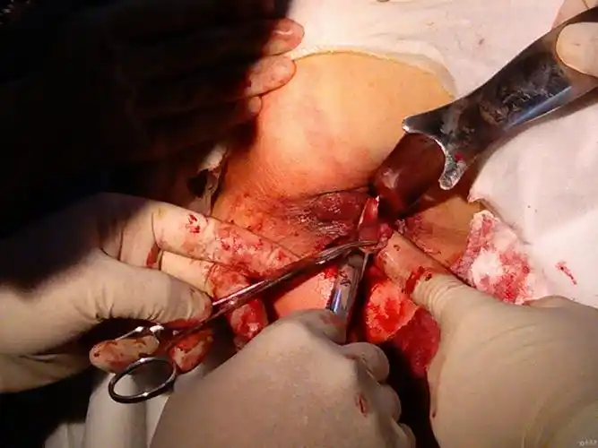 环状混合痔嵌顿伴血栓形成