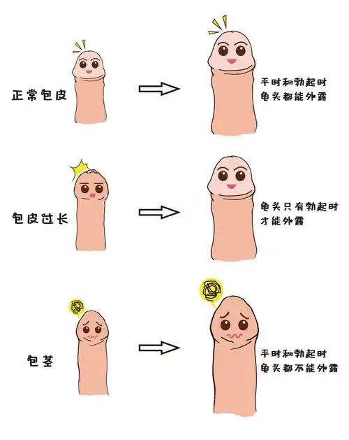 包茎包皮过长的危害有哪些