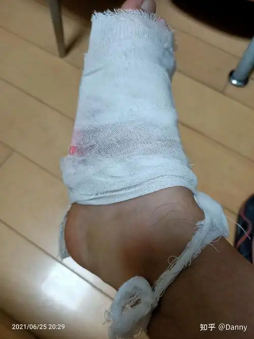 我的右脚第五趾骨骨折记录 - 知乎