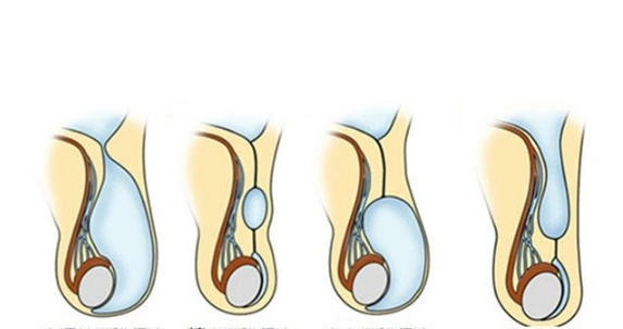 精索曲张睾丸下坠时图片 (9)