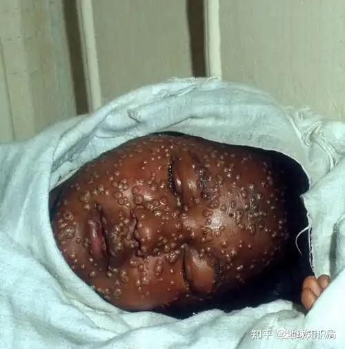 「天花」是一种怎样的传染病? - 知乎