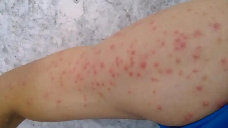 宜宾哪家医院治疗湿疹效果好