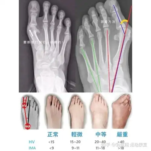 大脚趾外侧痛,一定是痛风吗?