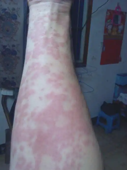 2014-02-02 赵洪顺 医师 荨麻疹性血管炎,快一年了,痒死了,全身不停地