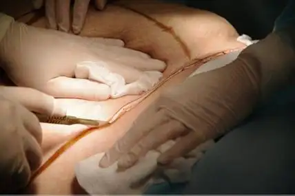 感冒的时候能进行抽脂手术吗