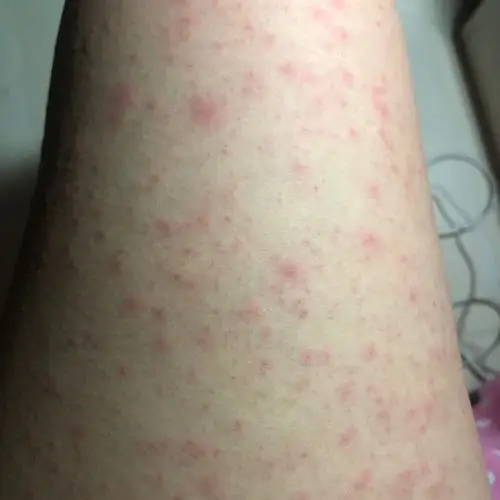 这是湿疹吗?今天早晨四肢突然出现?第一次