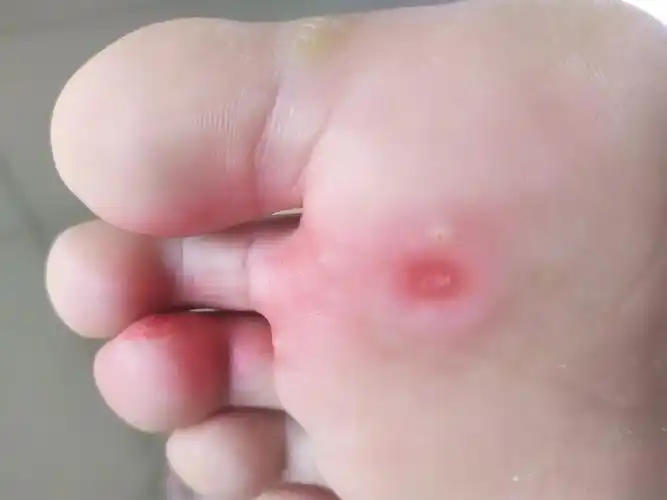 记录一下自己液氮冷冻后的跖疣