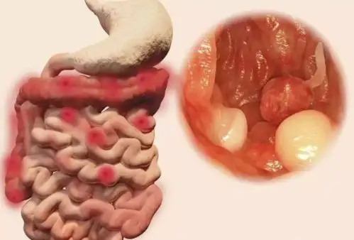 结节,息肉,囊肿,增生.哪个才是癌症的先兆? | 健康知识