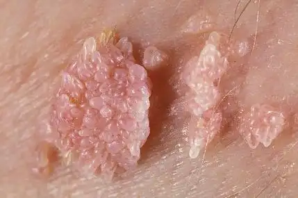 表现,有哪些 摘要:尖锐湿疣因患者的性别不同而有所不同,固然症状表现