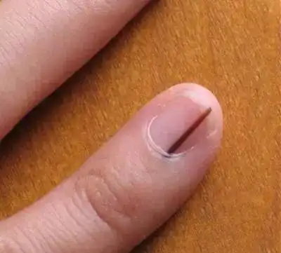 需引起注意,这可能甲母痣,其最常见的症状便是甲黑线,容易癌变成黑