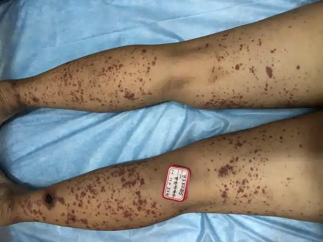 儿童紫癜肾炎症状有哪些?