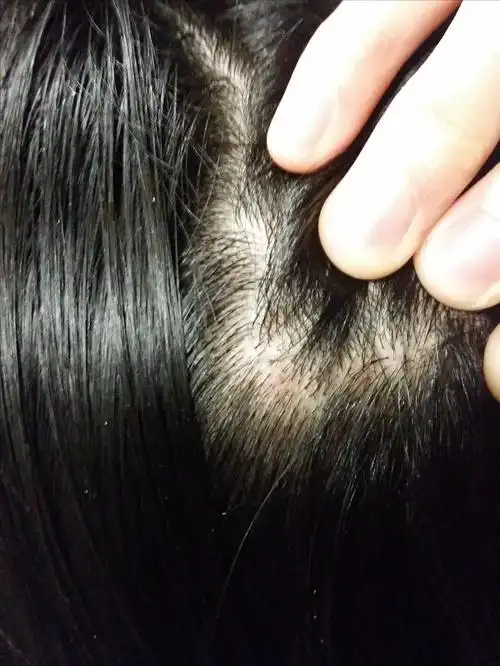 女生 医生说是头皮溢脂性皮炎,掉头发特厉害,求推荐治疗方法和洗发水.