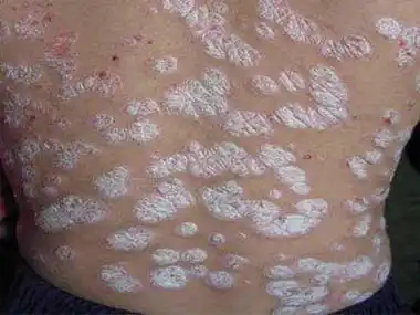 银屑病的临床表现有哪些