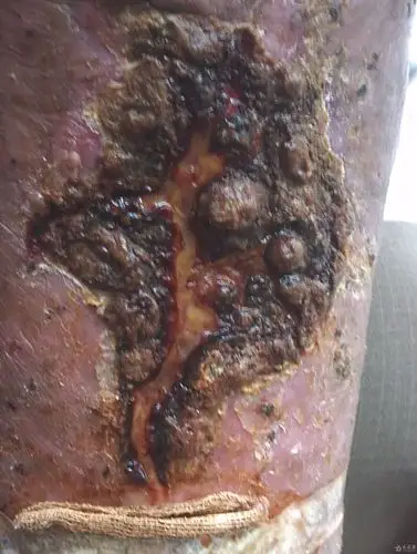 楼主wzytcm2014-06-03 15:24:58昨日接诊一病人,左下肢溃疡,有恶臭.