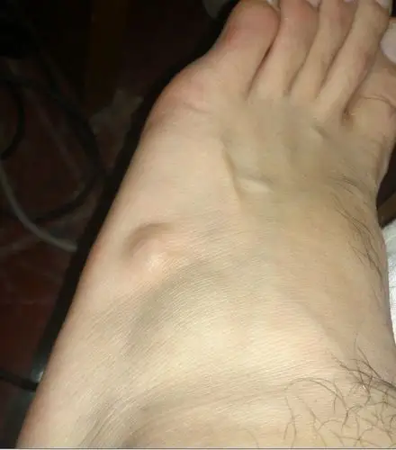 脚外侧上长了个小骨头,骨科专家帮我解答下啊!要专家啊!