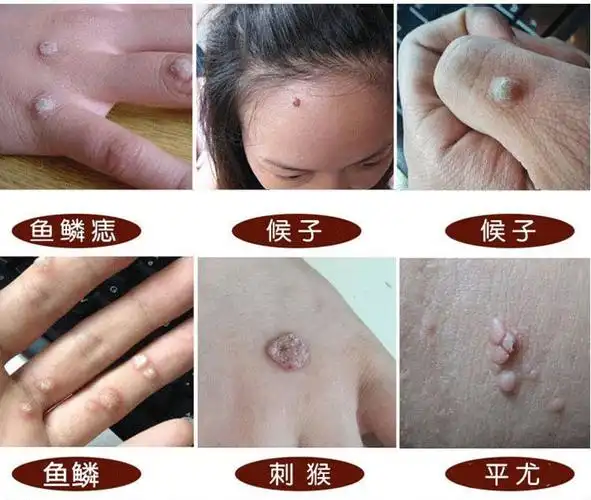 京健康鳞痣脚手上肉刺猴休子去猴子肉粒疙瘩的药点瘊子去除神器子去除