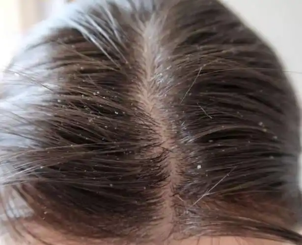 伴随着全身皮肤干燥或湿疹状态;3,干藓由头皮和头发的微菌感染所致