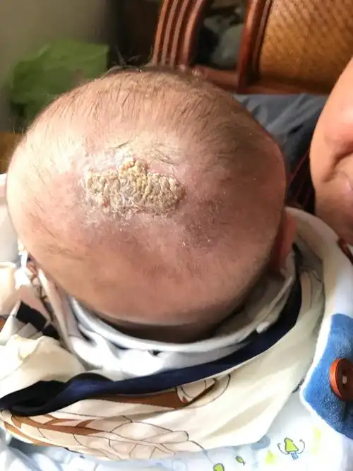 我家宝宝五个月大两三周以来后脑一直有的发红有时候有黄色的