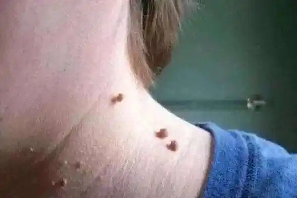 育儿嫂脖子长肉芽,查出hpv感染,医生:幸亏早发现,若传染给孩子可麻烦